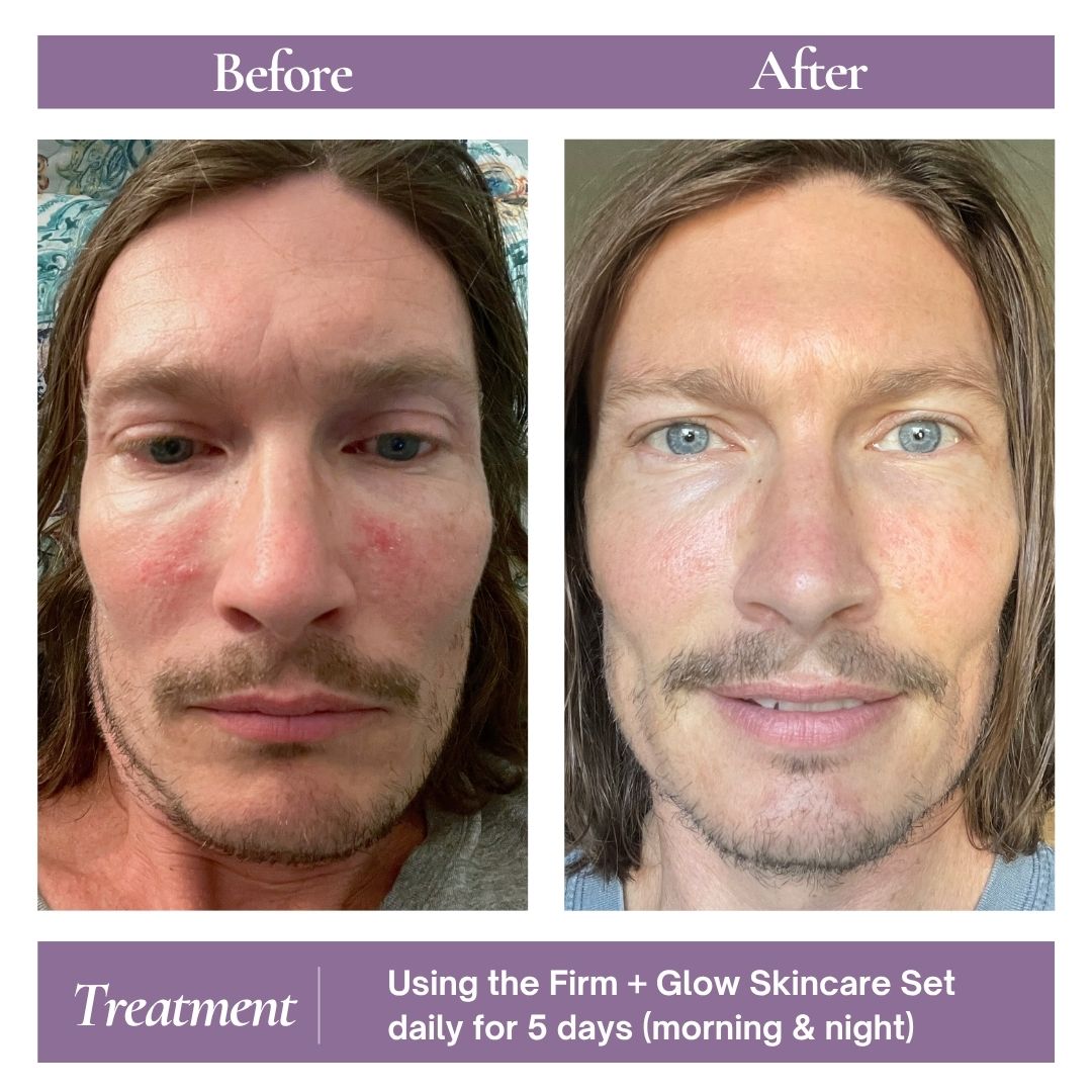 Calming Sensitive Skin in Fall & Winter: My 5-Day Transformation - AmaSKN Beauty