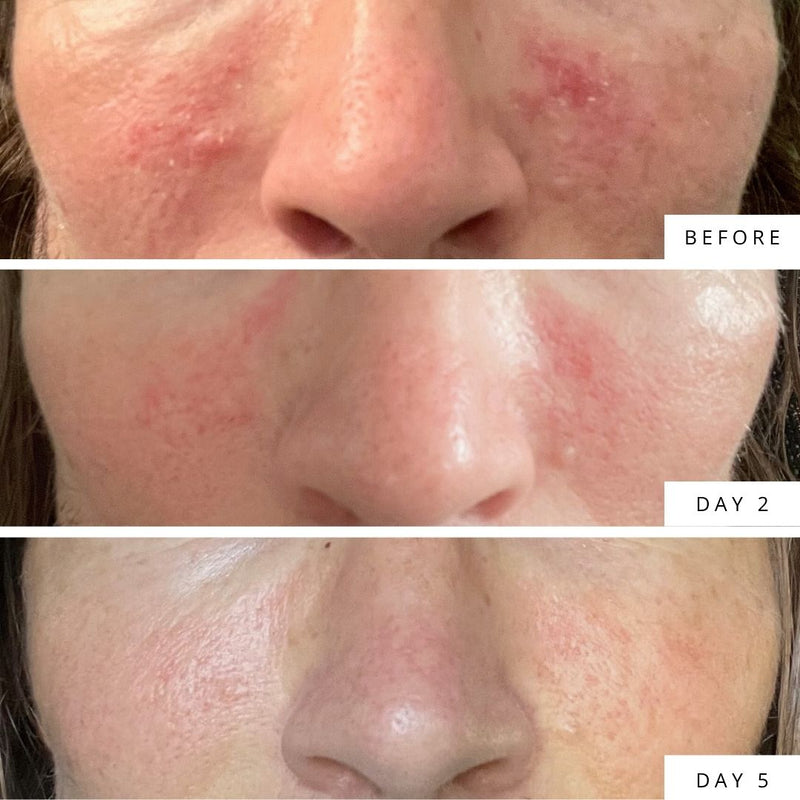 Calmer Skin before and after